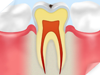 C0 【ごく初期の虫歯】