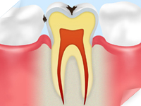 C1 【エナメル質の虫歯】