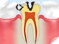 C2 【象牙質の虫歯】