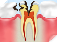 C3 【神経に達した虫歯】