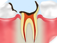 C4 【歯根に達した虫歯】