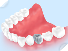 銀歯のデメリット