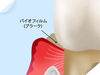 軽度歯周炎