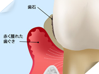 中等度歯周炎