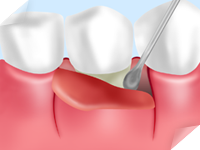 歯周ポケットそうは術